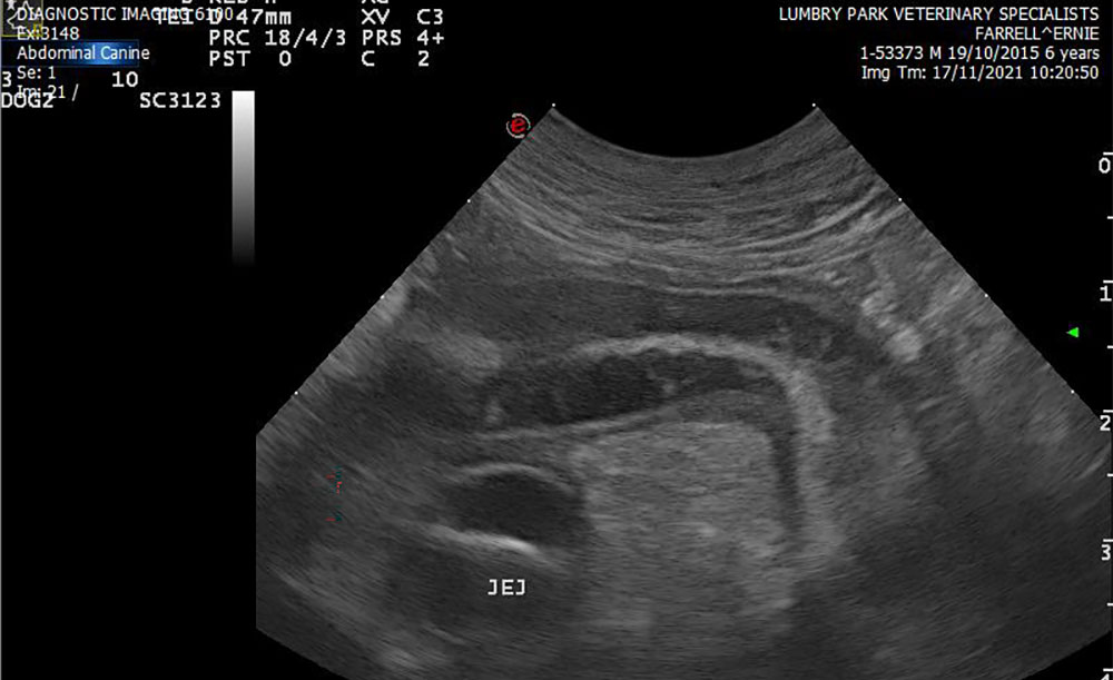 An Interesting Case Of Protein Losing Enteropathy