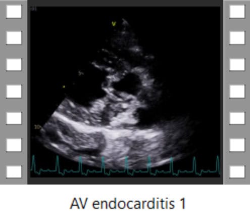 AV endocarditis 1