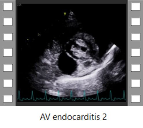 AV endocarditis 2