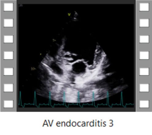 AV endocarditis 3