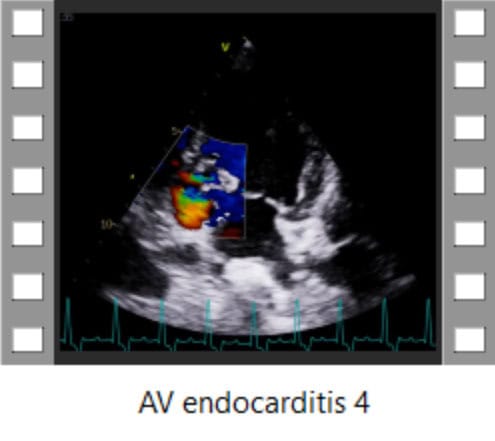 AV endocarditis 4