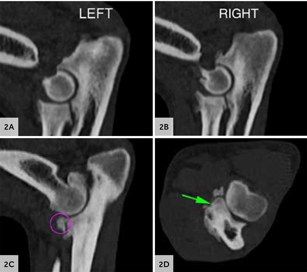 CT of the elbows